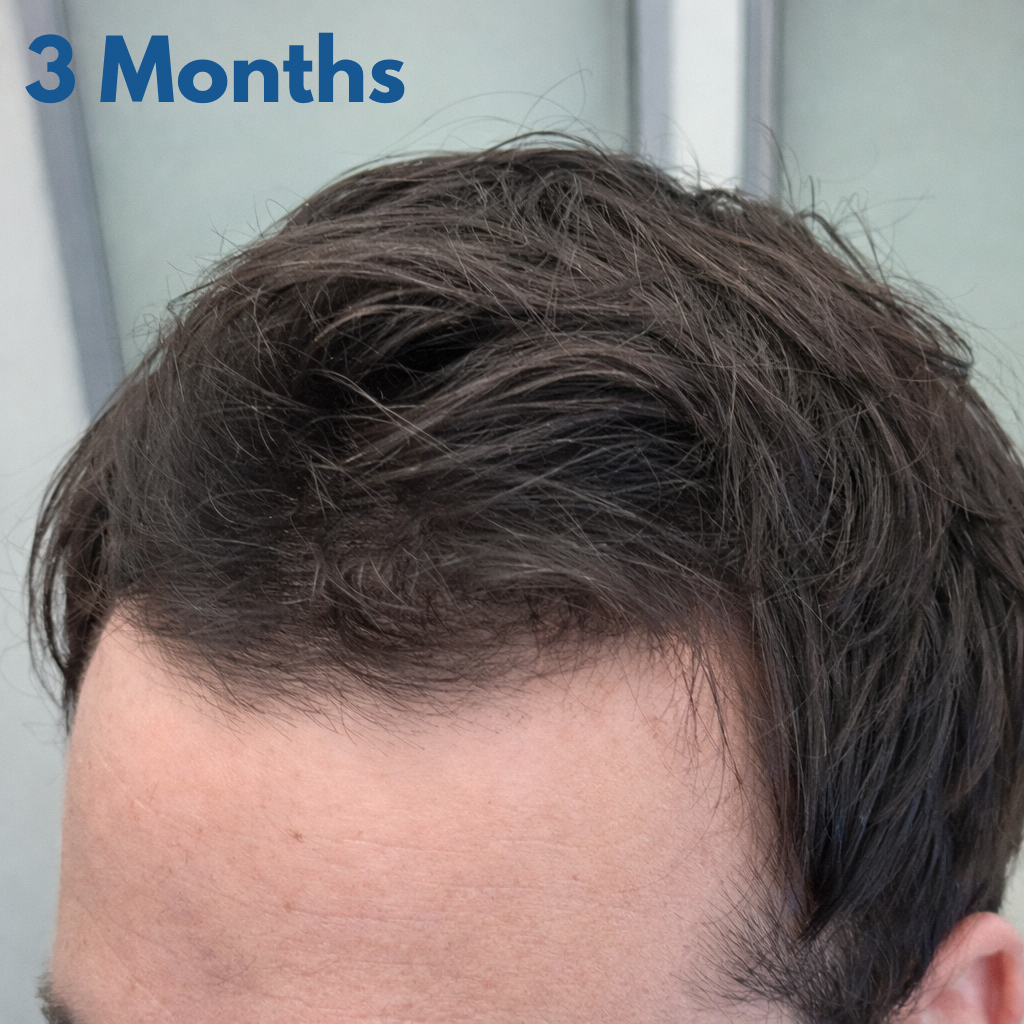 Close-up of a person's head with short, styled hair, labeled '3 Months'.