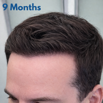 Close-up of a person with styled hair, labeled '9 Months'.